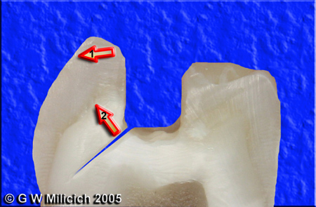 Cusp fracture1.2 small.jpg